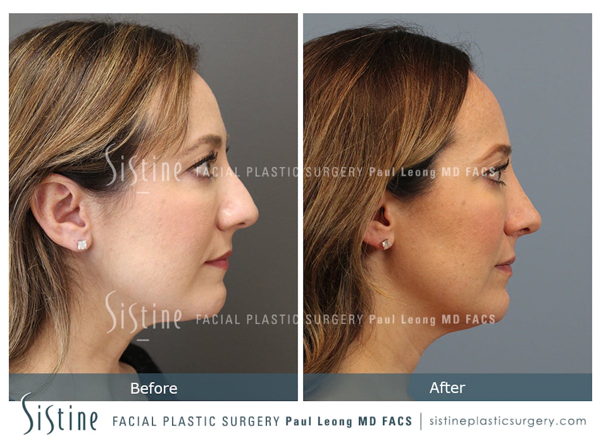 Rhinoplasty Before & After Gallery - Patient 245343 - Image 3