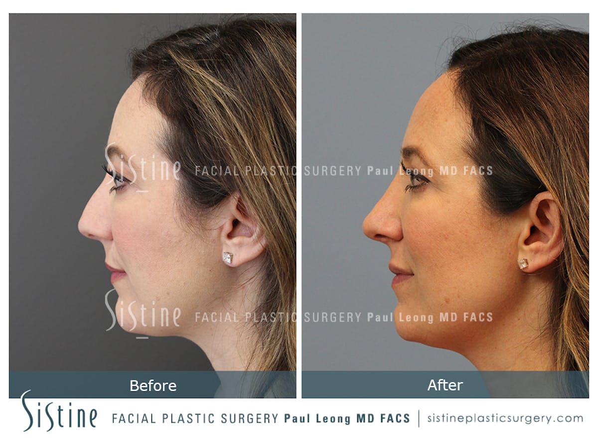 Rhinoplasty Before & After Gallery - Patient 245343 - Image 4