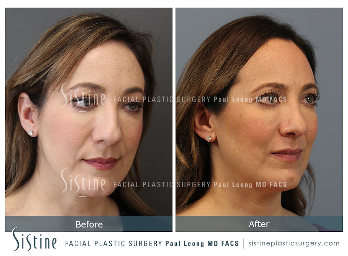 Rhinoplasty Before & After Gallery - Patient 245343 - Image 5