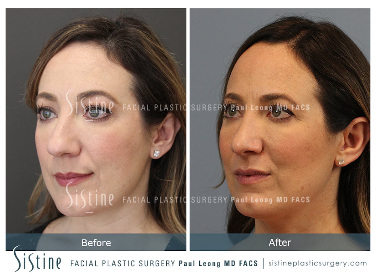 Rhinoplasty Before & After Gallery - Patient 245343 - Image 6