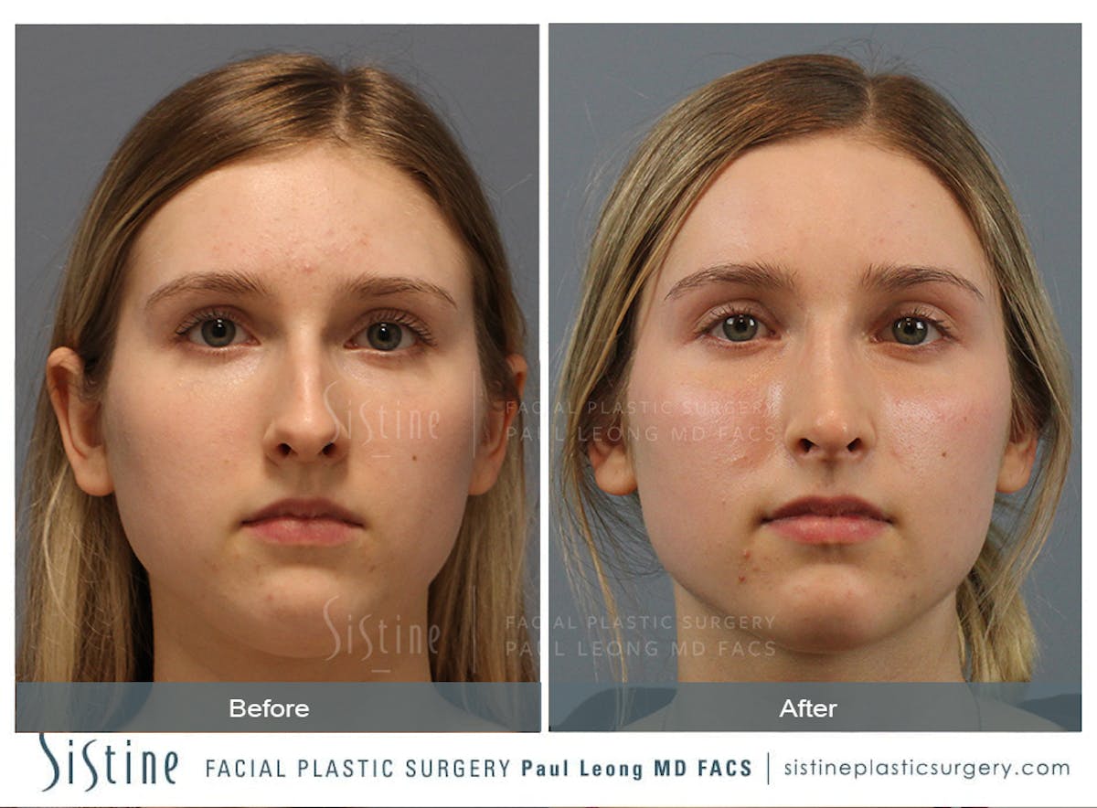 Rhinoplasty Before & After Gallery - Patient 150811 - Image 1