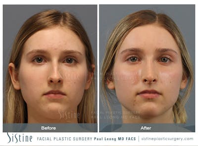 Rhinoplasty Before & After Gallery - Patient 150811 - Image 1