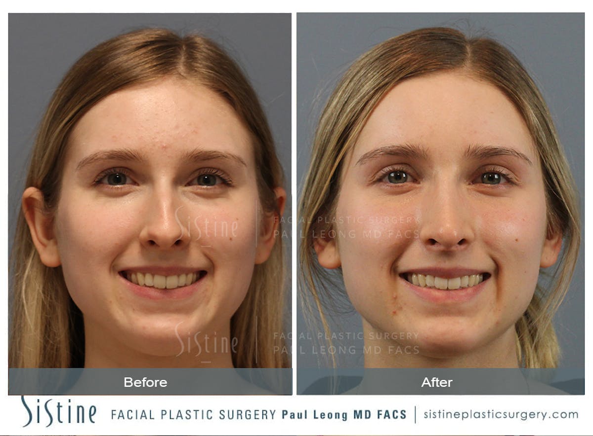 Rhinoplasty Before & After Gallery - Patient 150811 - Image 2