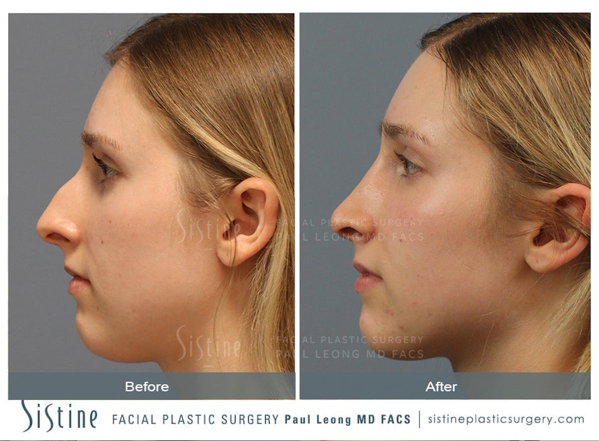 Rhinoplasty Before & After Gallery - Patient 150811 - Image 3