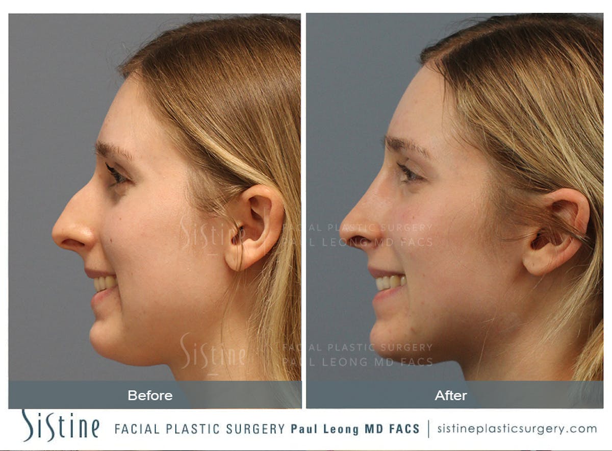 Rhinoplasty Before & After Gallery - Patient 150811 - Image 4