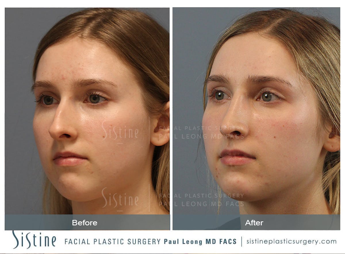 Rhinoplasty Before & After Gallery - Patient 150811 - Image 5