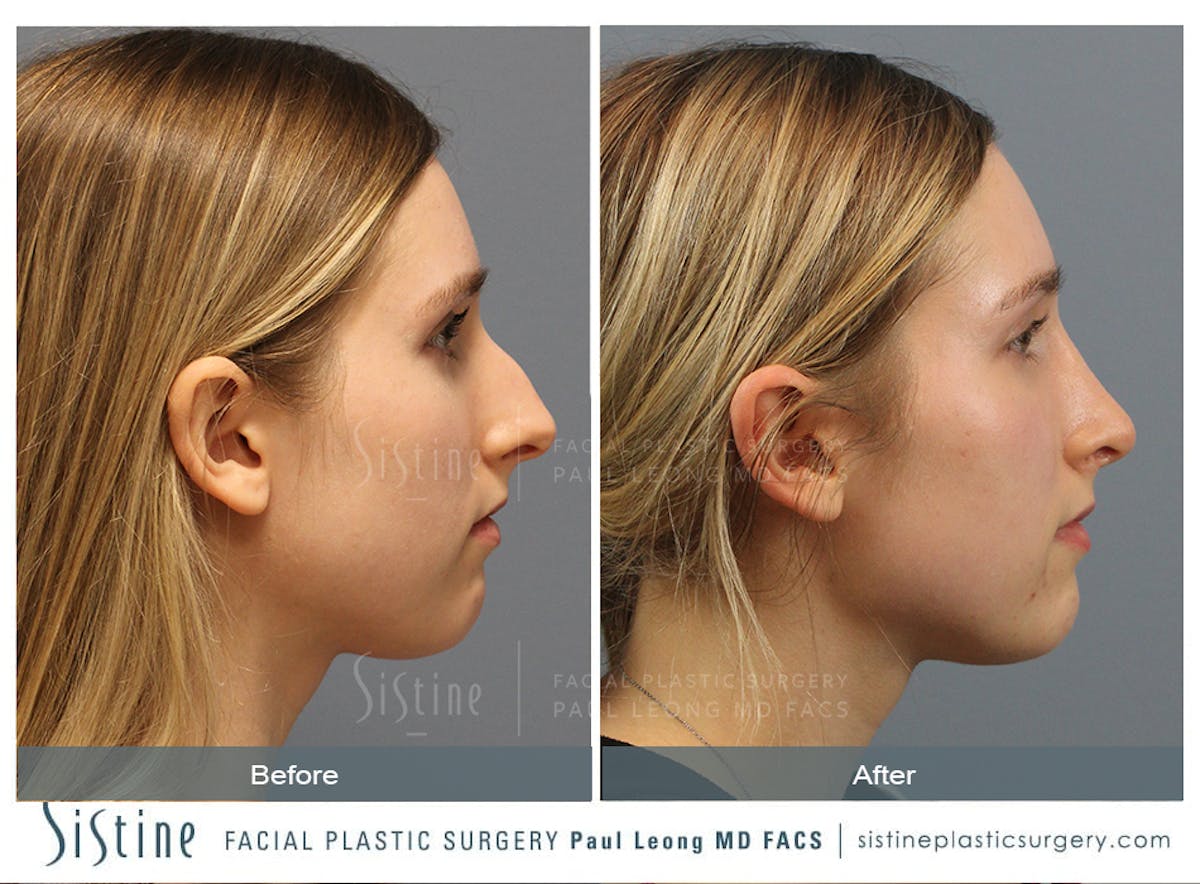 Rhinoplasty Before & After Gallery - Patient 150811 - Image 6