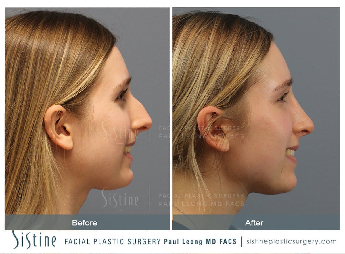 Rhinoplasty Before & After Gallery - Patient 150811 - Image 7