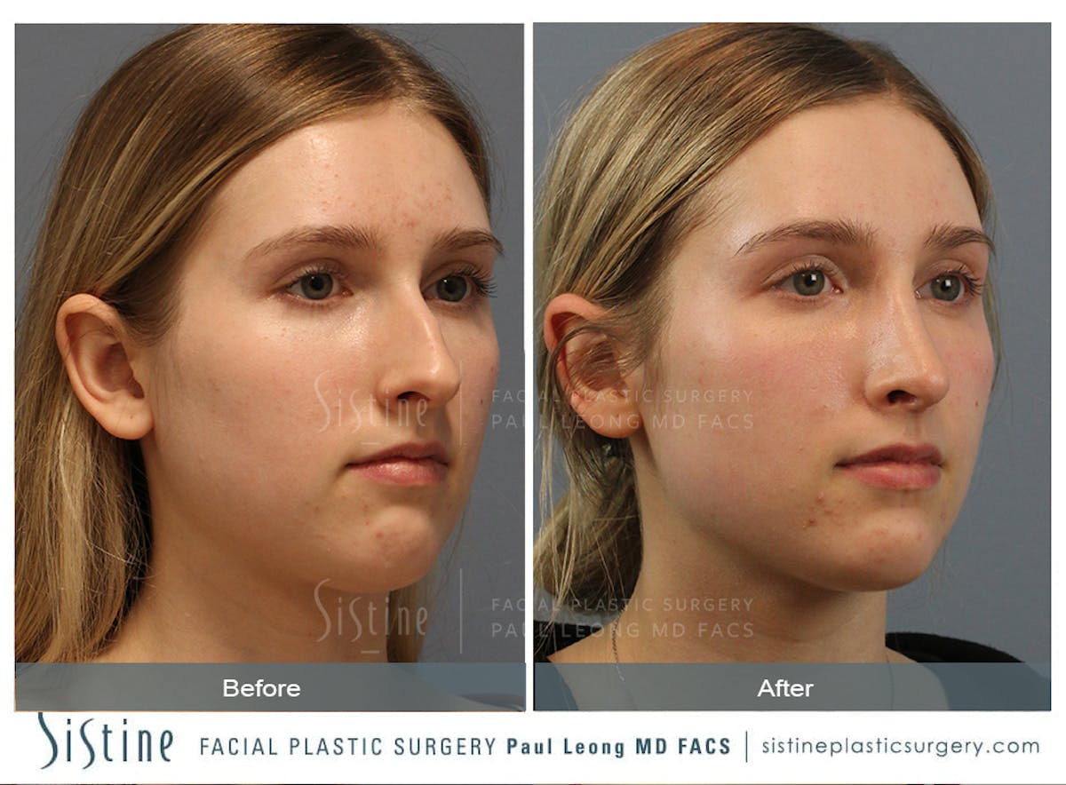 Rhinoplasty Before & After Gallery - Patient 150811 - Image 8