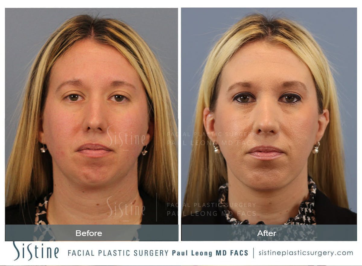 Rhinoplasty Before & After Gallery - Patient 533377 - Image 1