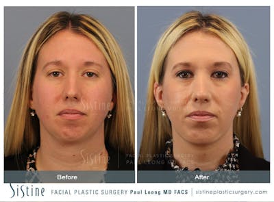 Chin Jaw And Neck Before & After Gallery - Patient 136636 - Image 1