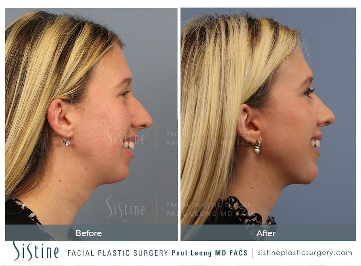 Rhinoplasty Before & After Gallery - Patient 533377 - Image 2