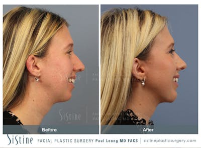 Chin Implant Before & After Gallery - Patient 238121 - Image 1