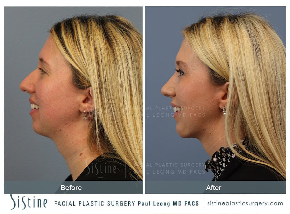 Rhinoplasty Before & After Gallery - Patient 533377 - Image 3