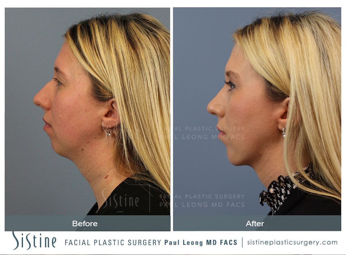 Rhinoplasty Before & After Gallery - Patient 533377 - Image 4