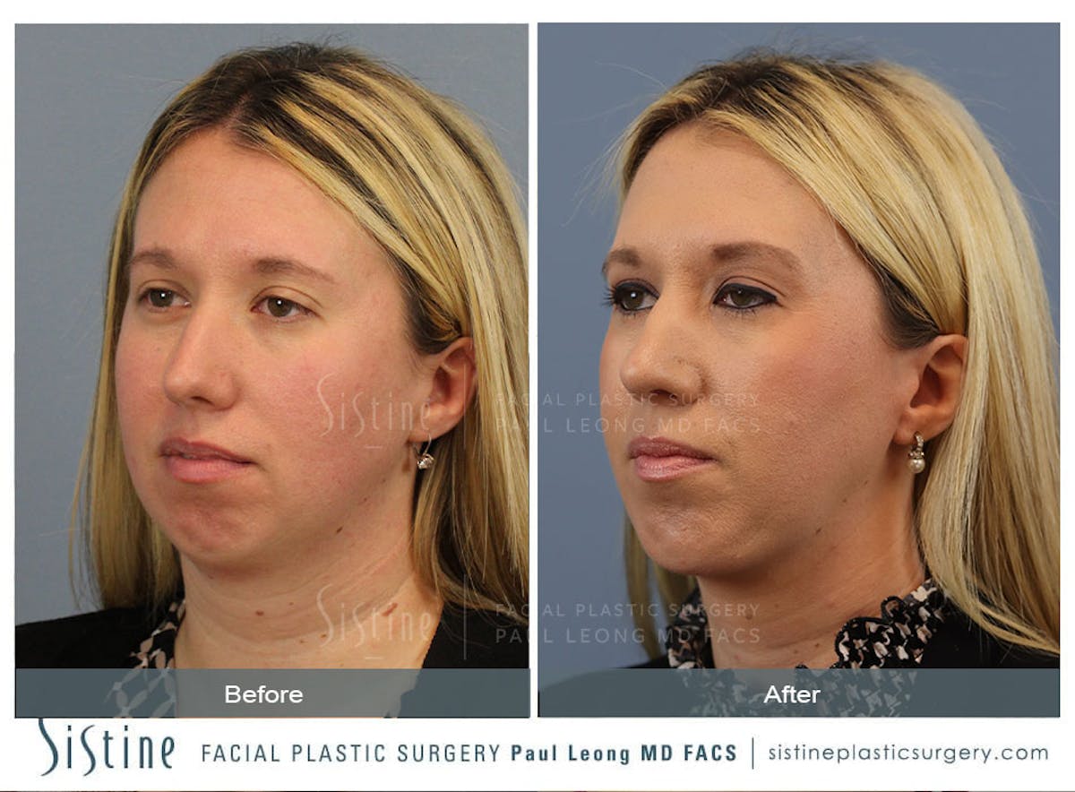 Rhinoplasty Before & After Gallery - Patient 533377 - Image 5