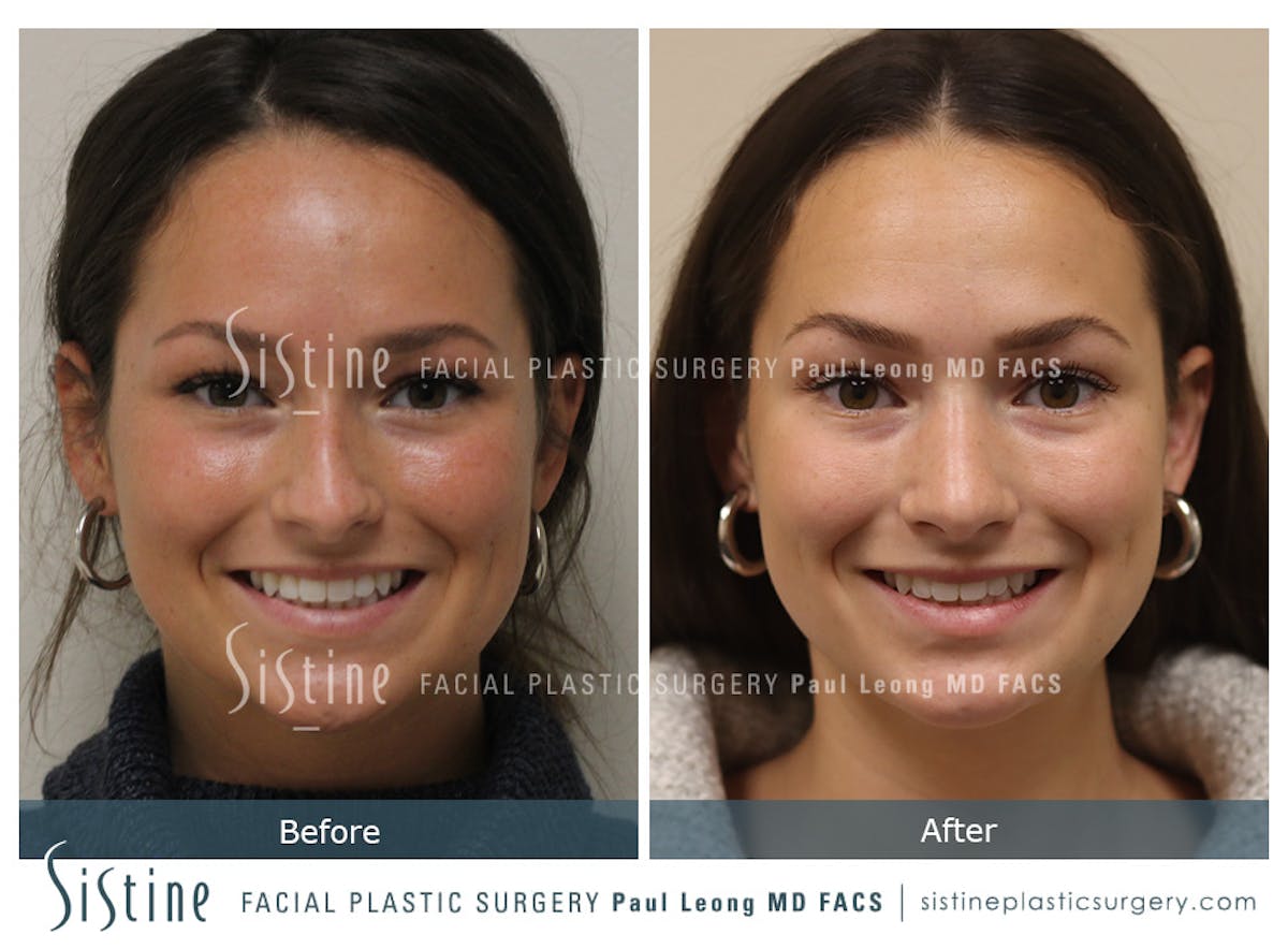 Rhinoplasty Before & After Gallery - Patient 386499 - Image 1