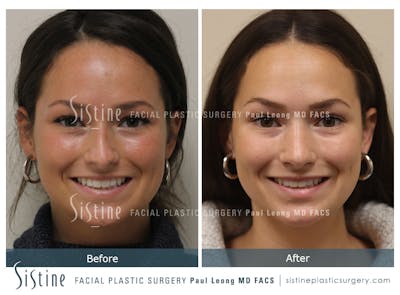 Rhinoplasty Before & After Gallery - Patient 386499 - Image 1