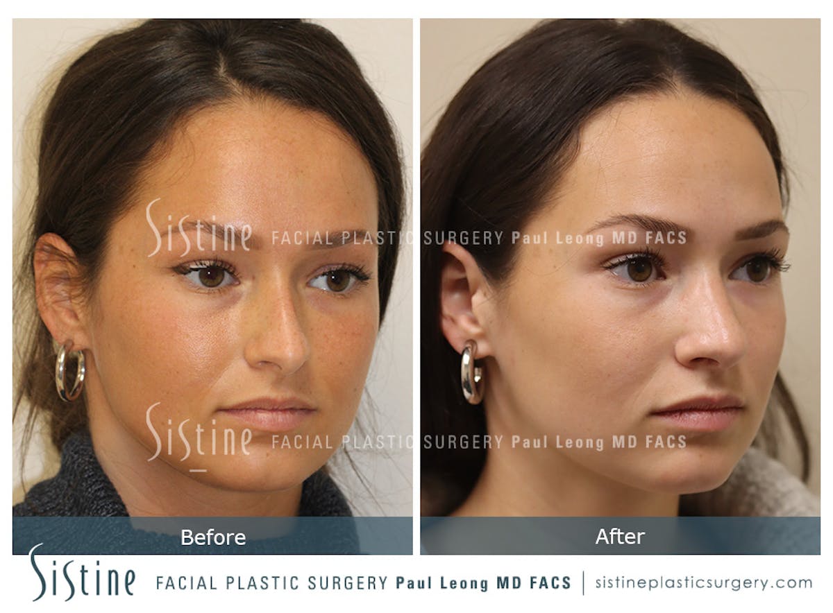 Rhinoplasty Before & After Gallery - Patient 386499 - Image 2