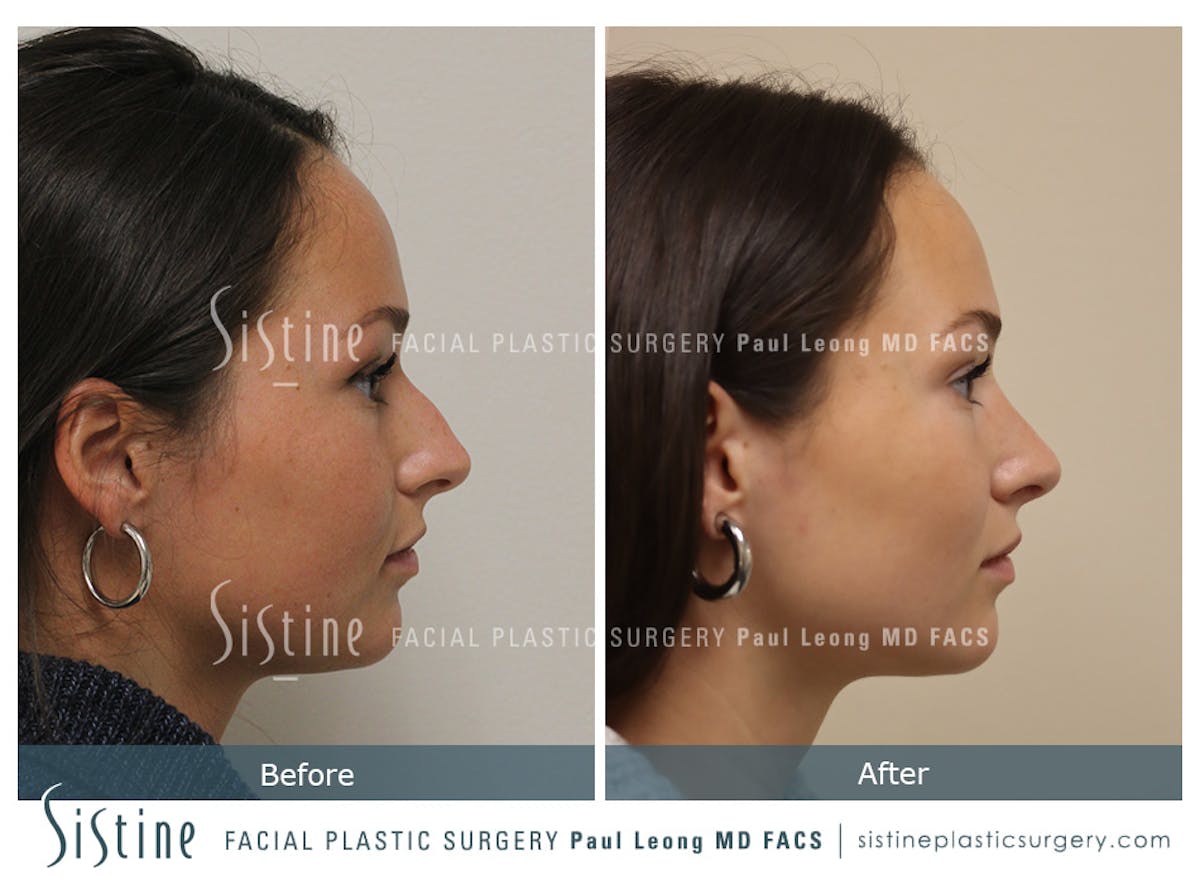 Rhinoplasty Before & After Gallery - Patient 386499 - Image 3