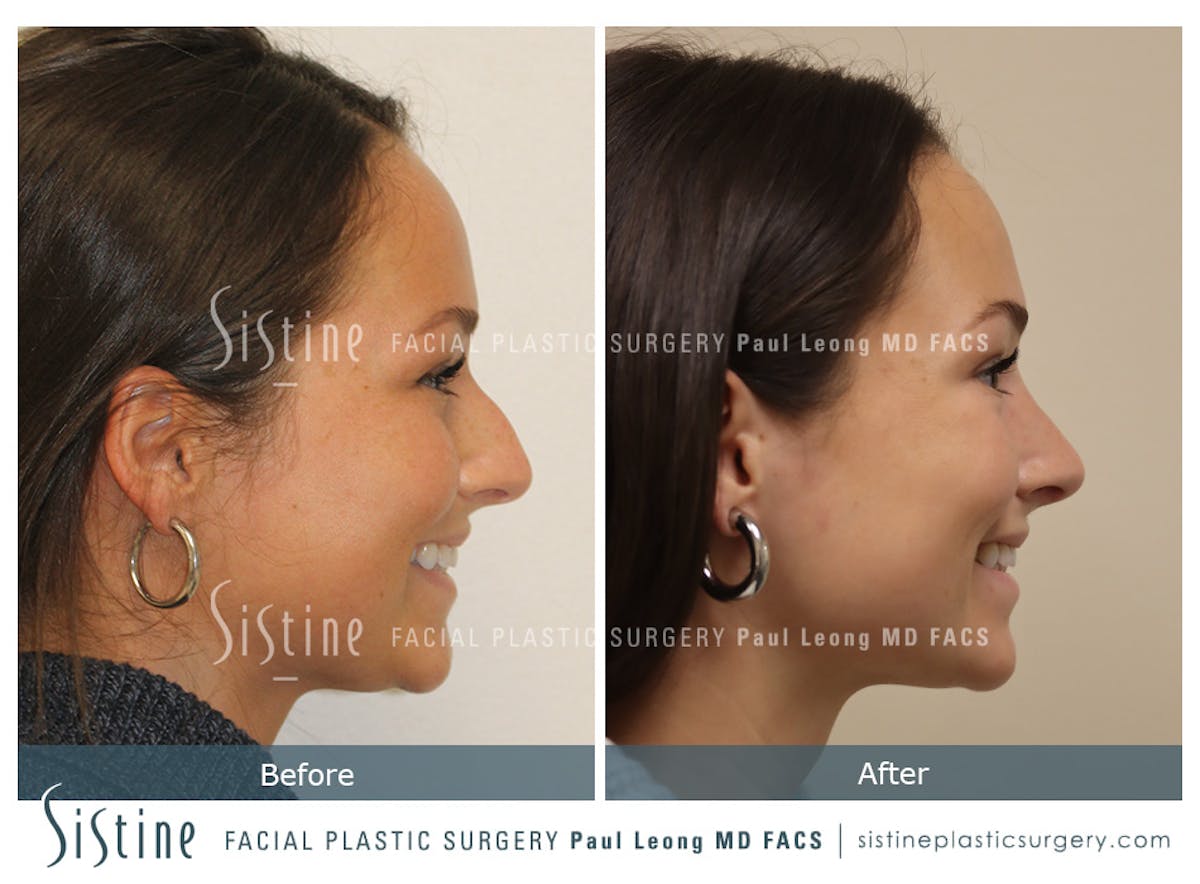 Rhinoplasty Before & After Gallery - Patient 386499 - Image 4
