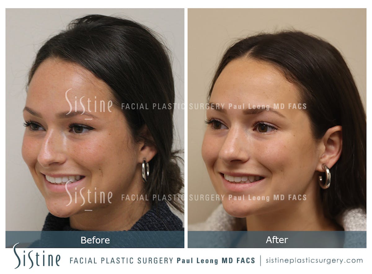 Rhinoplasty Before & After Gallery - Patient 386499 - Image 5