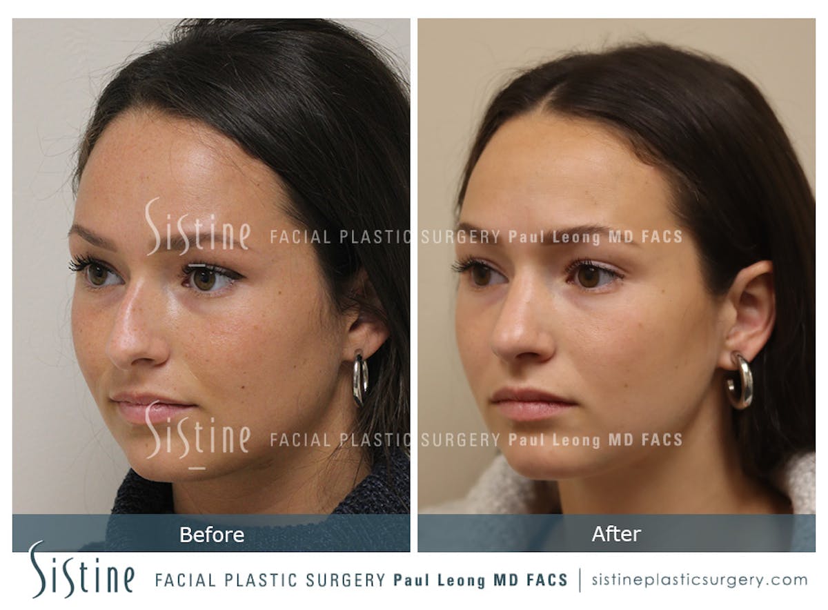 Rhinoplasty Before & After Gallery - Patient 386499 - Image 6