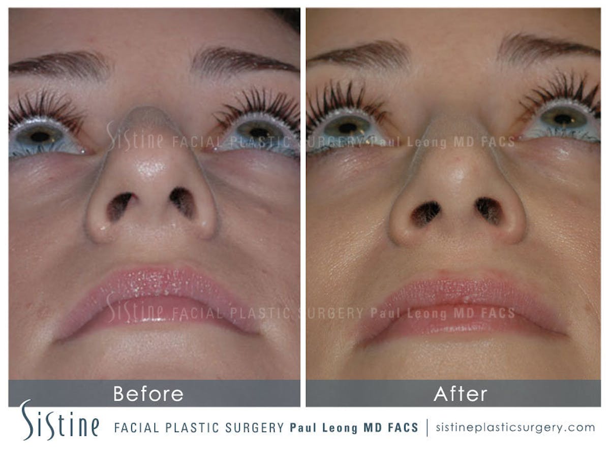 Nose Before & After Gallery - Patient 191772 - Image 6