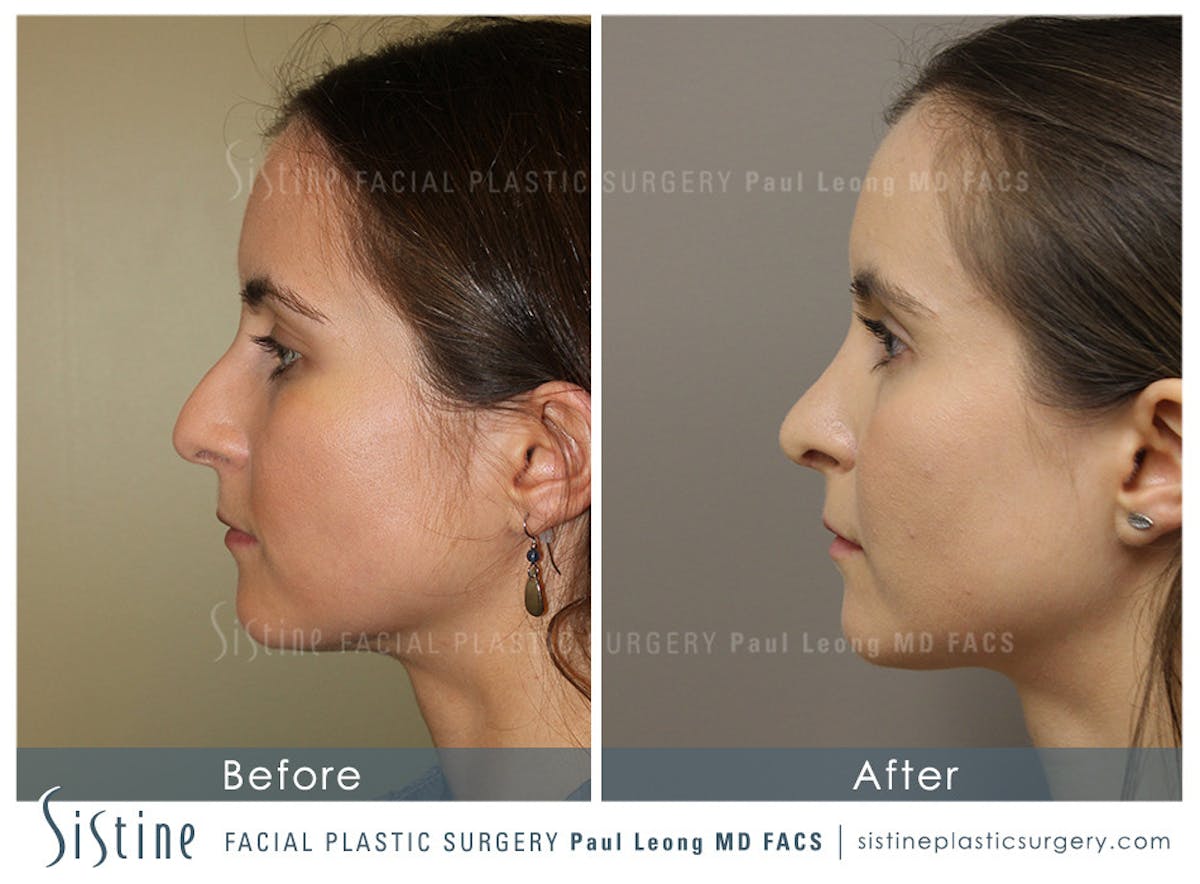 Nose Before & After Gallery - Patient 405029 - Image 1