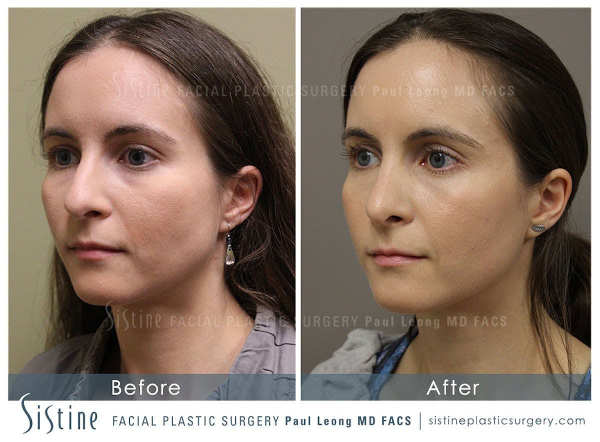 Nose Before & After Gallery - Patient 405029 - Image 3