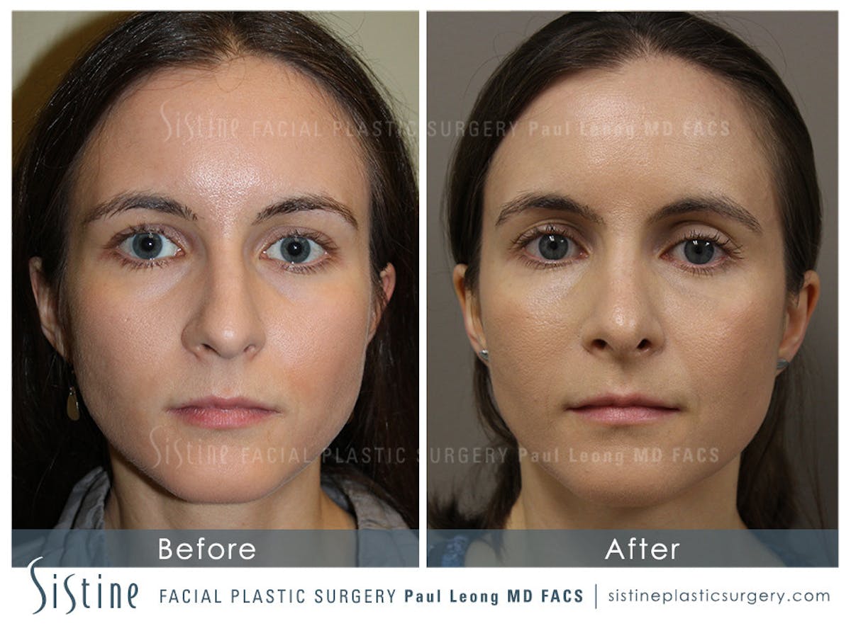 Nose Before & After Gallery - Patient 405029 - Image 4