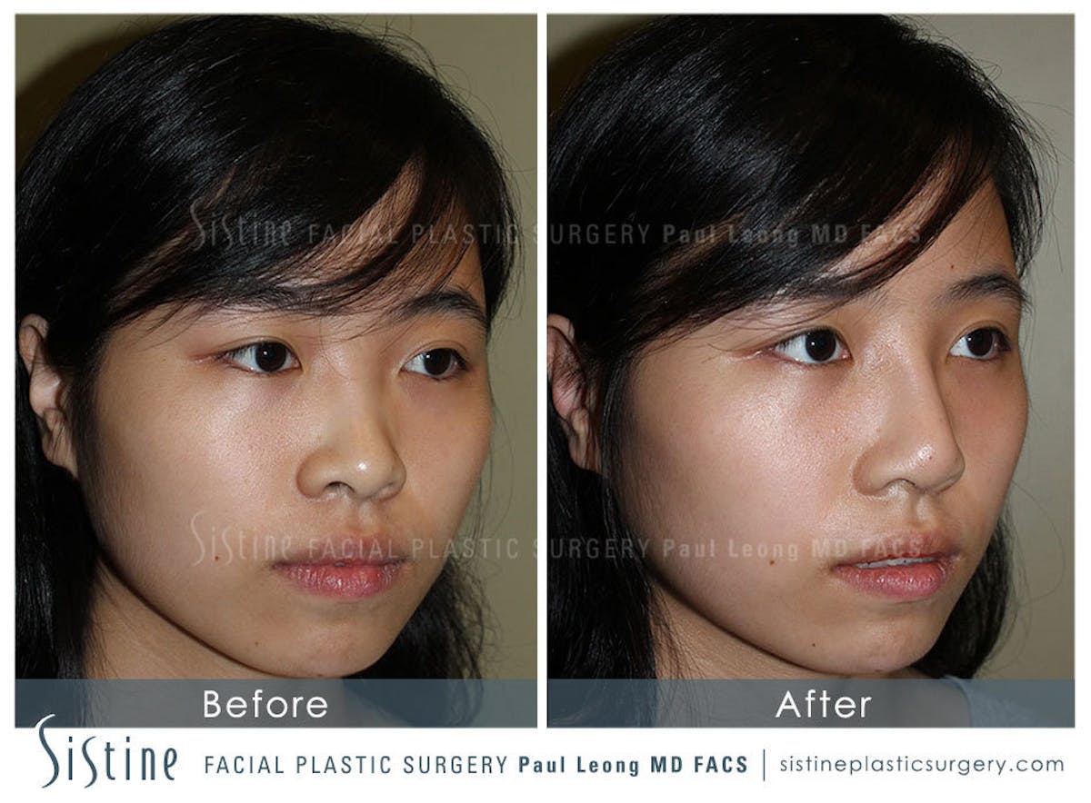 Nose Before & After Gallery - Patient 375361 - Image 2