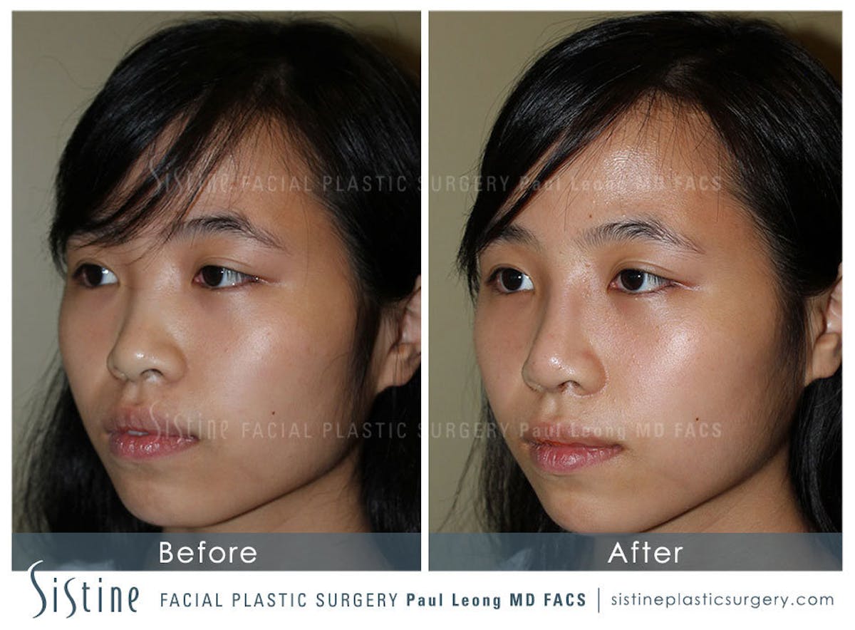 Nose Before & After Gallery - Patient 375361 - Image 3