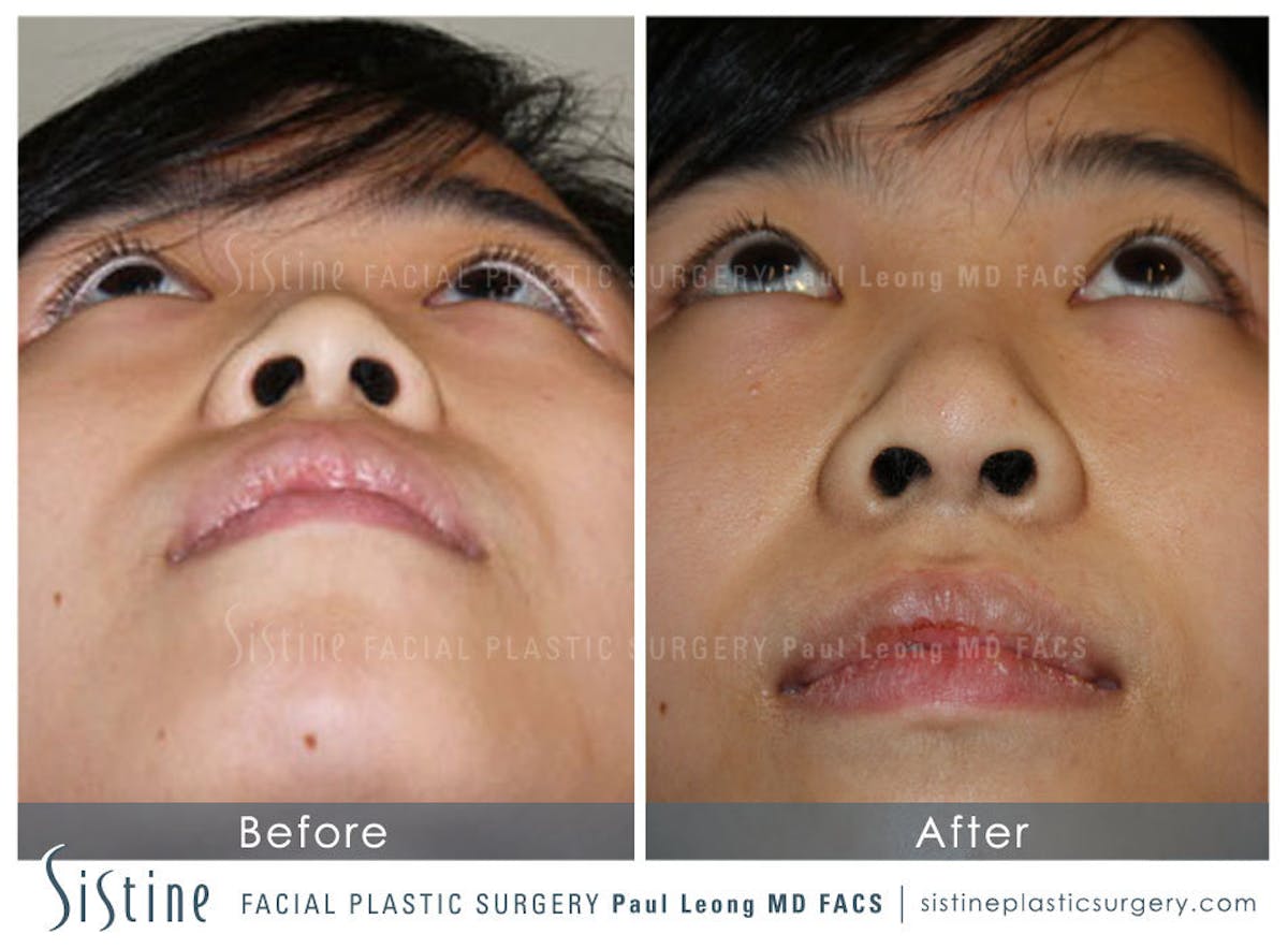 Nose Before & After Gallery - Patient 375361 - Image 6