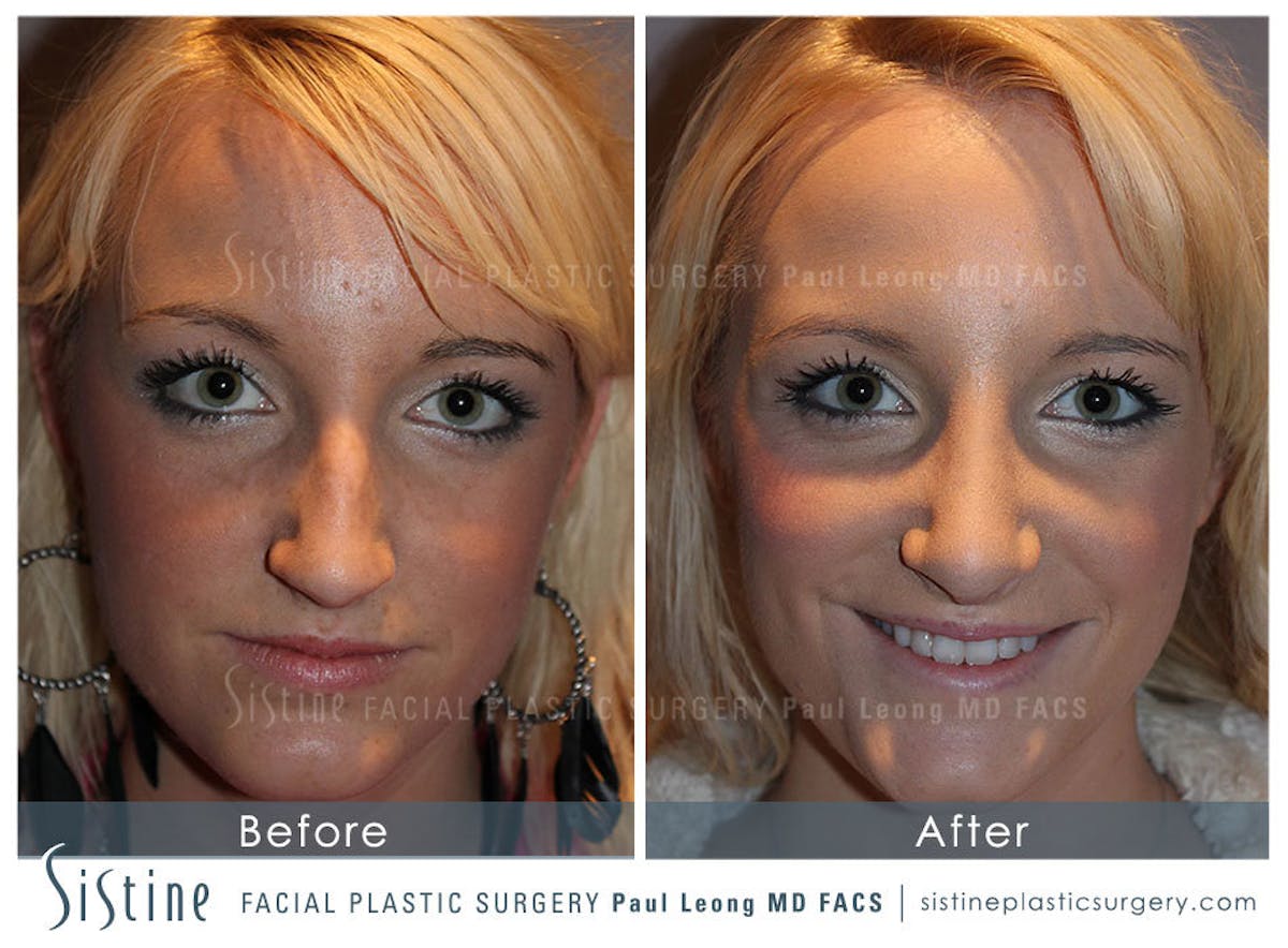 Nose Before & After Gallery - Patient 722097 - Image 1
