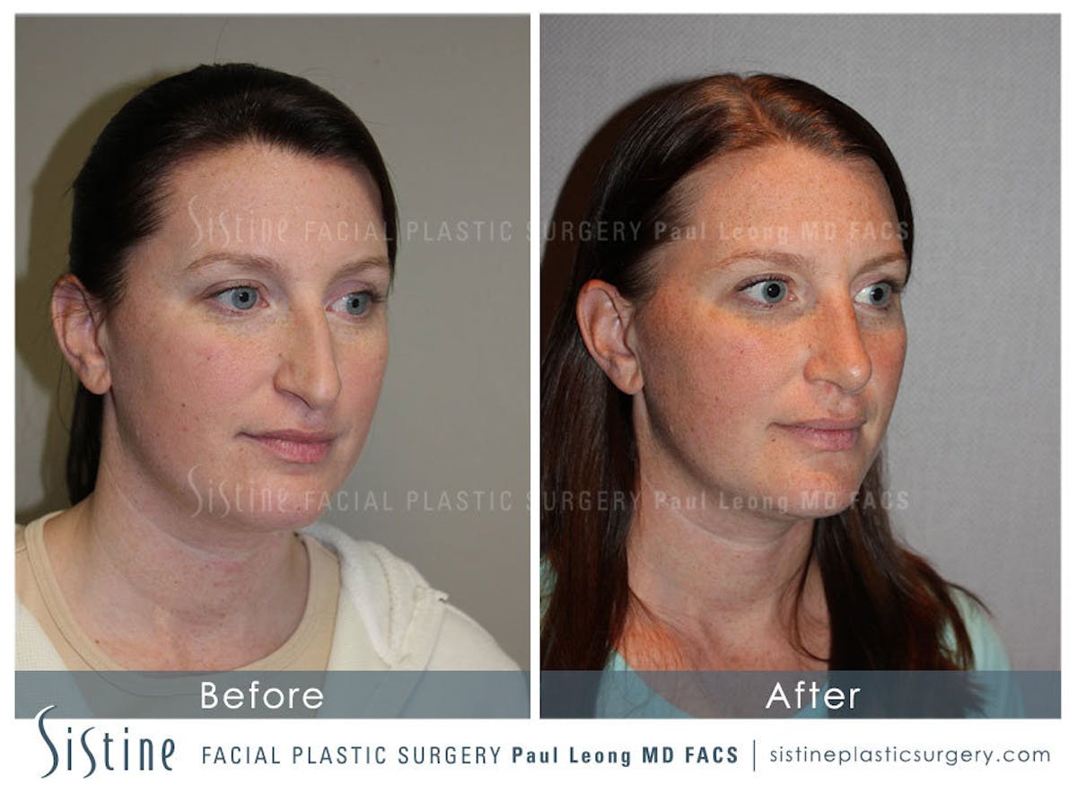 Nose Before & After Gallery - Patient 429297 - Image 3