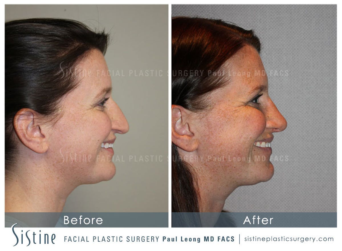 Nose Before & After Gallery - Patient 429297 - Image 6