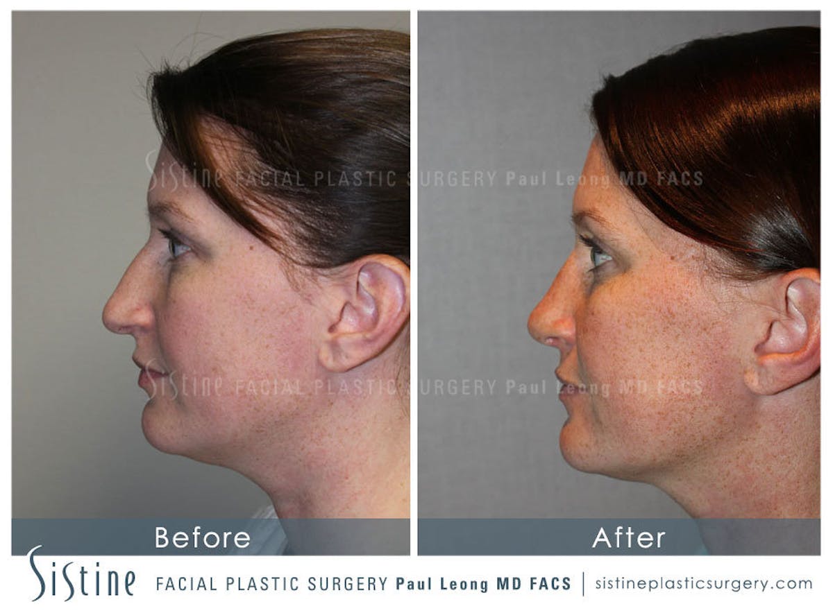 Nose Before & After Gallery - Patient 429297 - Image 7