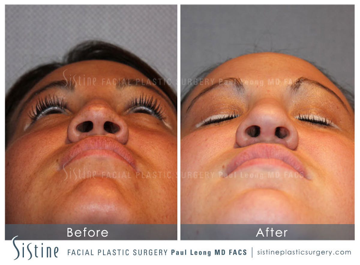Nose Before & After Gallery - Patient 402375 - Image 6