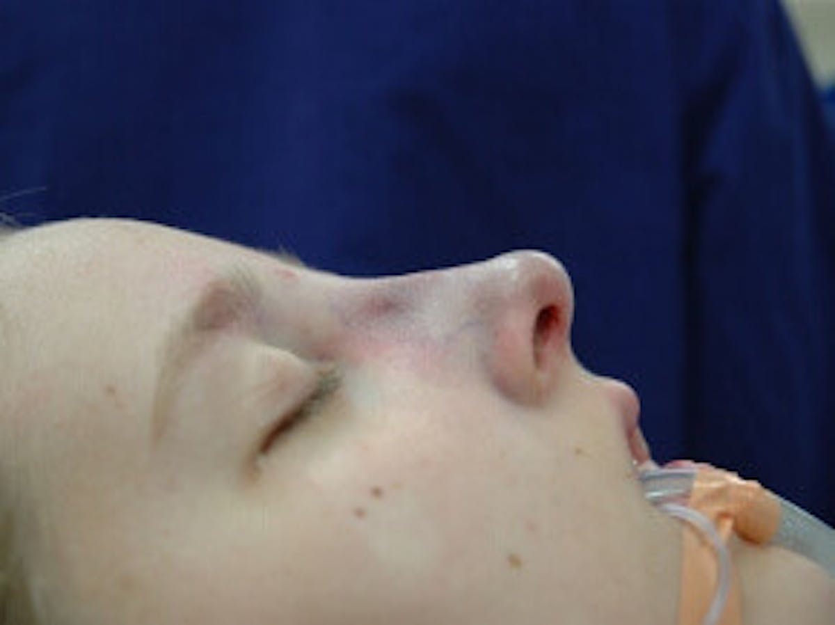Nose Before & After Gallery - Patient 321846 - Image 4