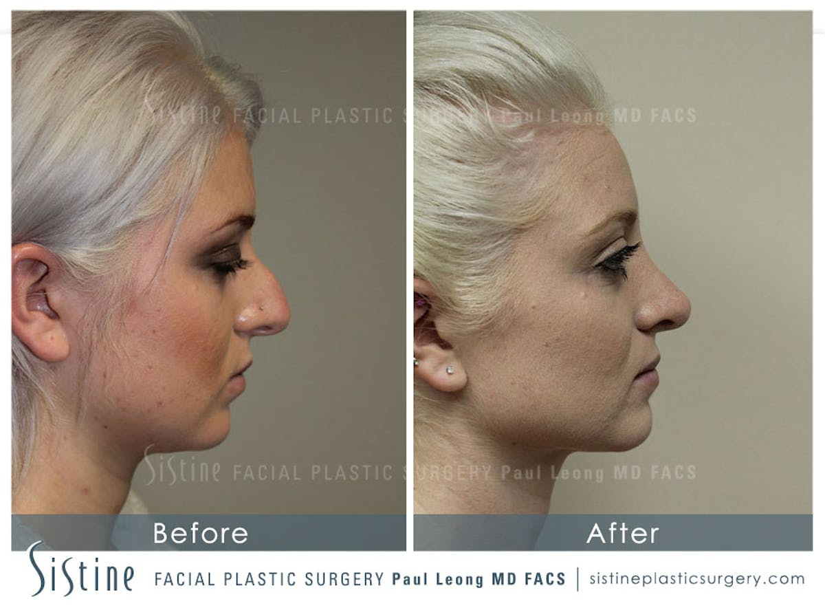 Nose Before & After Gallery - Patient 392305 - Image 2
