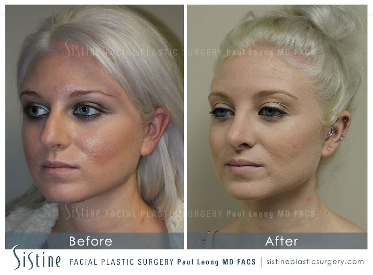 Nose Before & After Gallery - Patient 392305 - Image 5