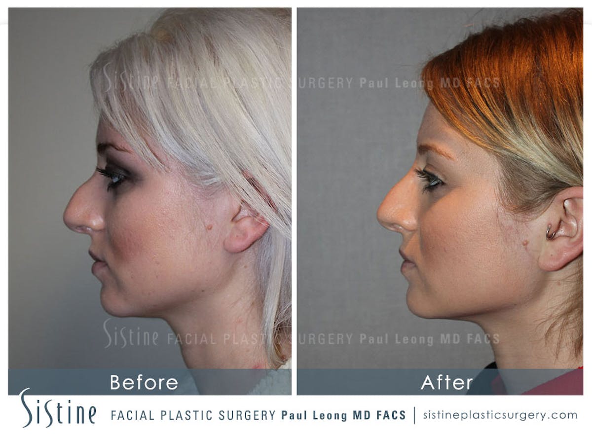 Nose Before & After Gallery - Patient 232382 - Image 1