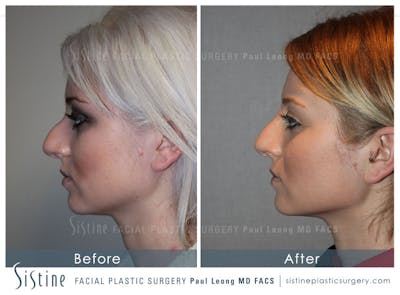 Nose Before & After Gallery - Patient 232382 - Image 1
