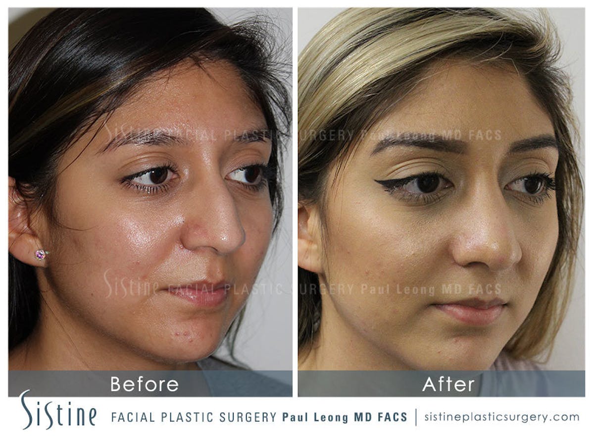 Nose Before & After Gallery - Patient 167999 - Image 4