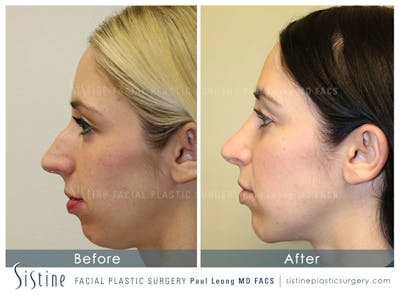 Nose Before & After Gallery - Patient 137137 - Image 1