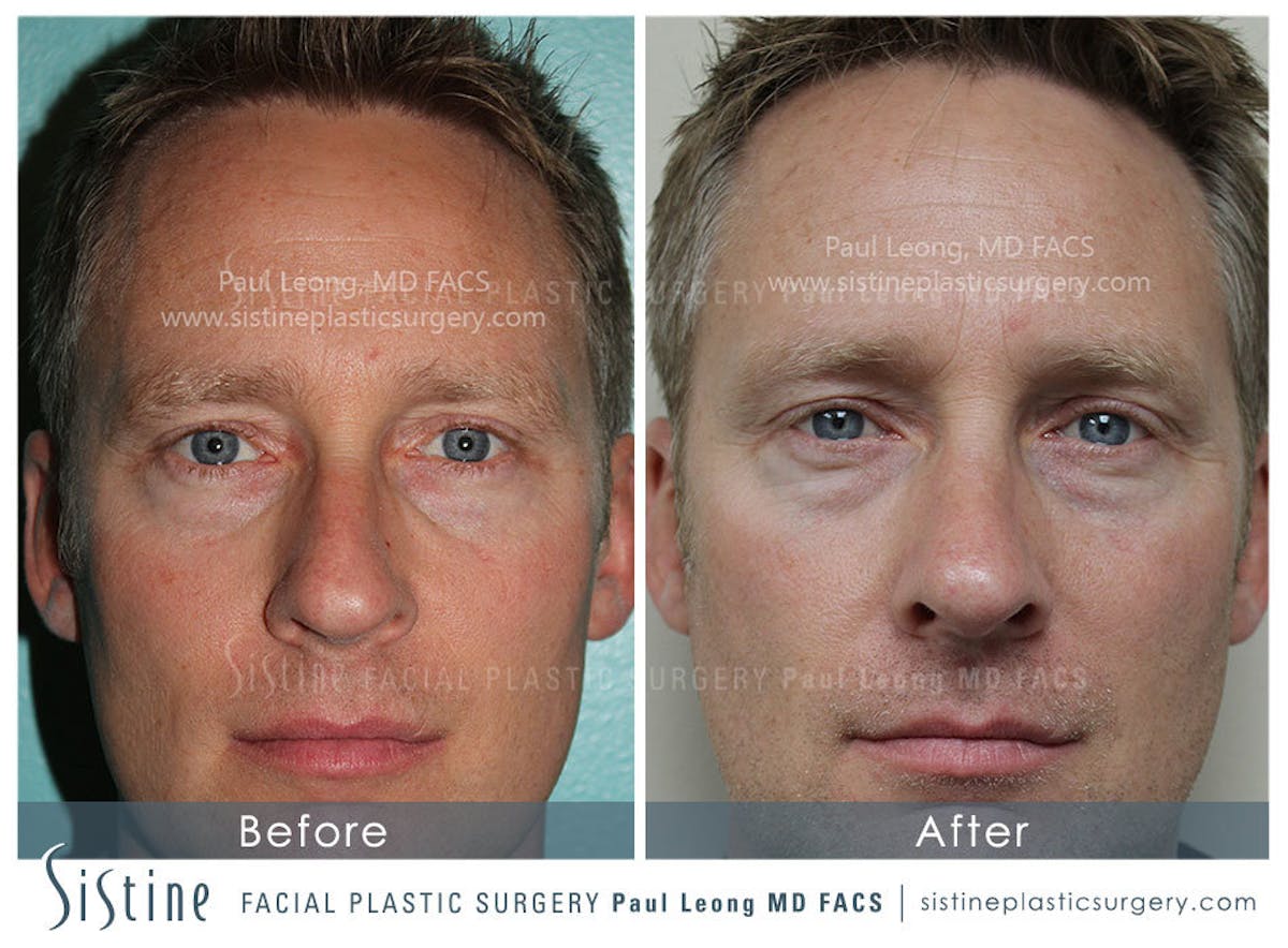 Rhinoplasty Before & After Gallery - Patient 732887 - Image 1