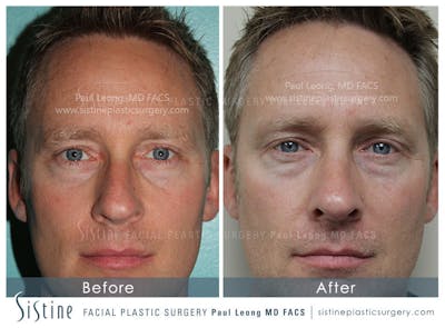 Nose Before & After Gallery - Patient 402323 - Image 1