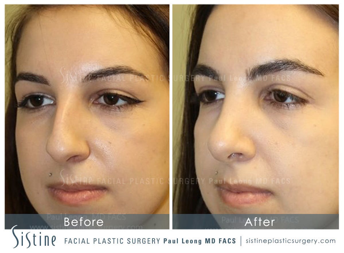 Nose Before & After Gallery - Patient 380710 - Image 4