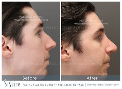 Nose Before & After Gallery - Patient 362593 - Image 1